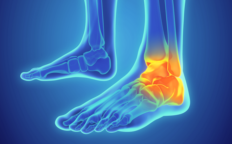 Total Ankle Replacement