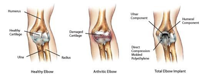 Anatomical graphic of elbow arthritis