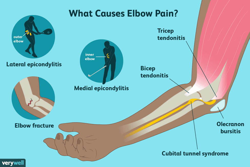 Anatomical graphic of what causes elbow pain and elbow arthritis