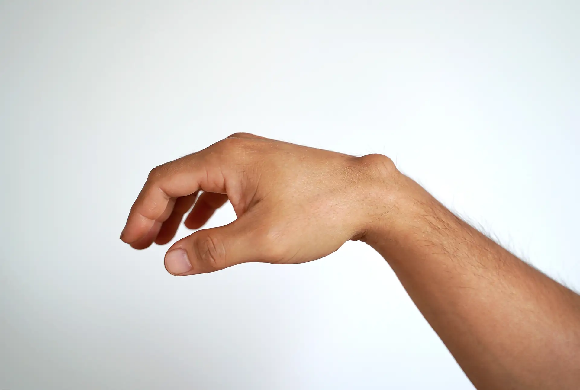 Ganglion Cysts
