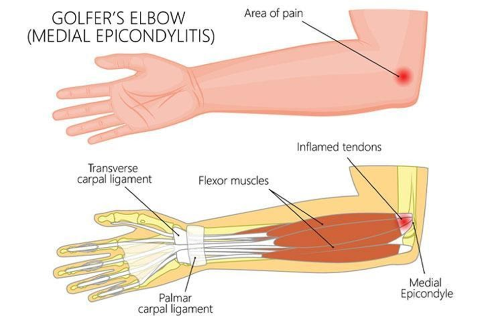 Anatomical Graphic of Golfers Elbow