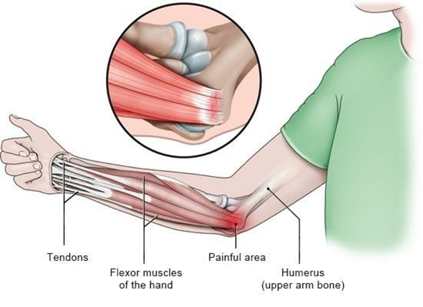 Symptoms of Golfers Elbow