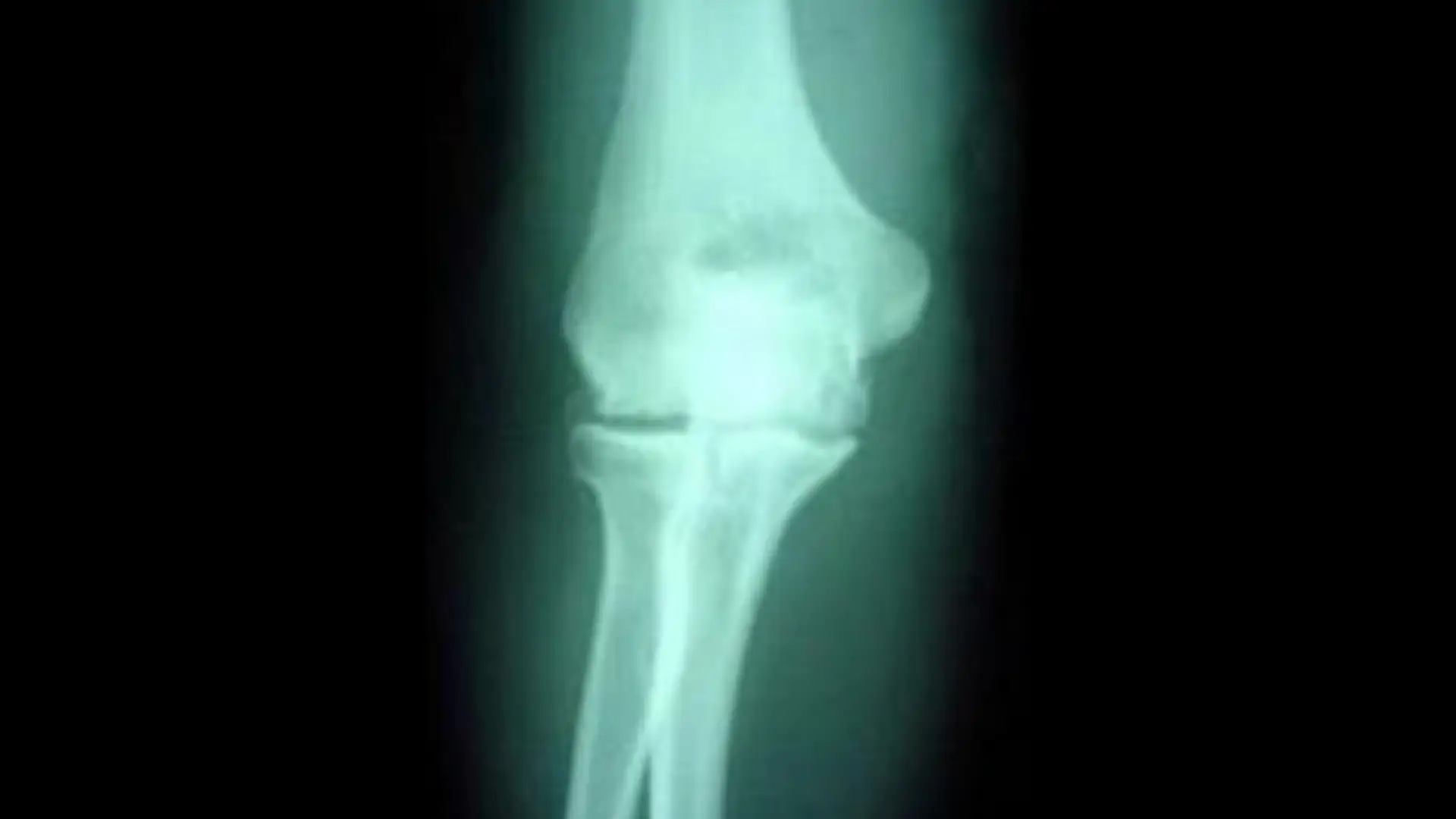Loose Bone Fragment in Elbow – Causes