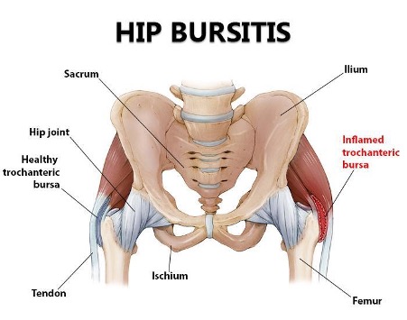 Anatomical graphic of hip bursitis