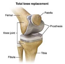 Anatomical graphic of Total Knee Replacement