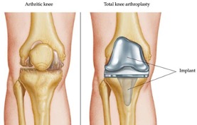 Arthritic Knee vs Total Knee Replacement Implant