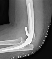 Total elbow replacement x-ray view