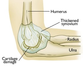elbow joint diagram with damaged cartilage