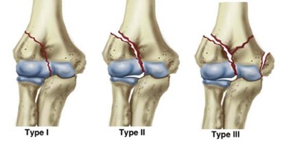 Type one, two, and three of damaged elbow joint in need of replacement
