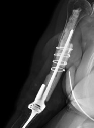 X-ray view of total elbow replacement procedure