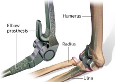 Technology used in total elbow replacement including an elbow prosthesis