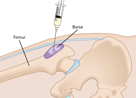 Anatomical graphic of treatment process for Hip Bursitis