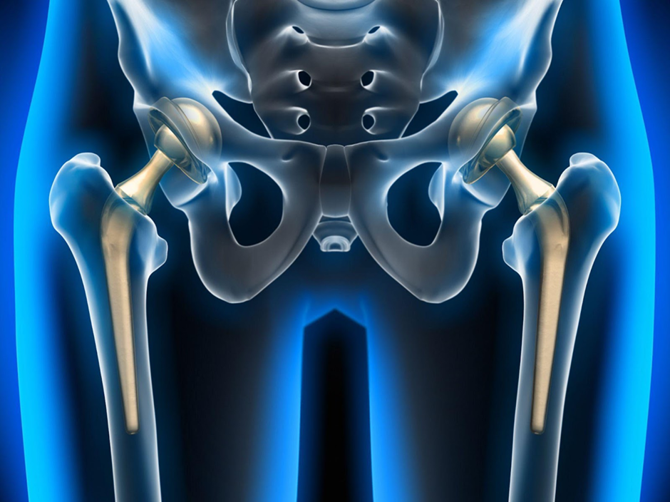 Total Hip Replacement (Arthroplasty)