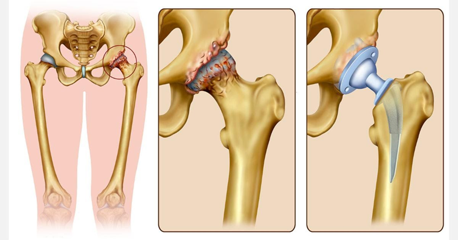 Anatomical graphic of hips needing a replacement and replacement process