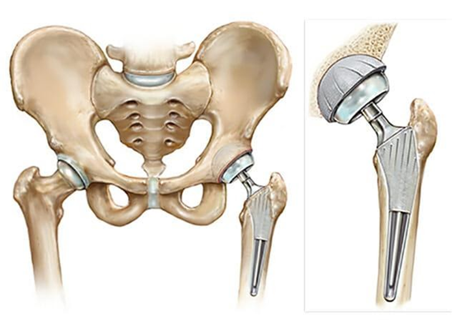 Hip Replacement Implant Image
