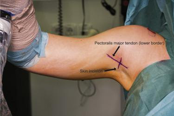 Pectoralis major tendon and skin incision labels on patient bicep