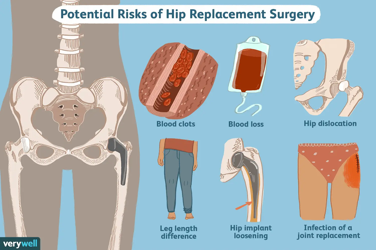 Potential Risk of Hip Replacement Surgery graphic