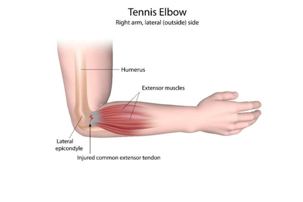 Anatomical graphic of PRP for tennis elbow