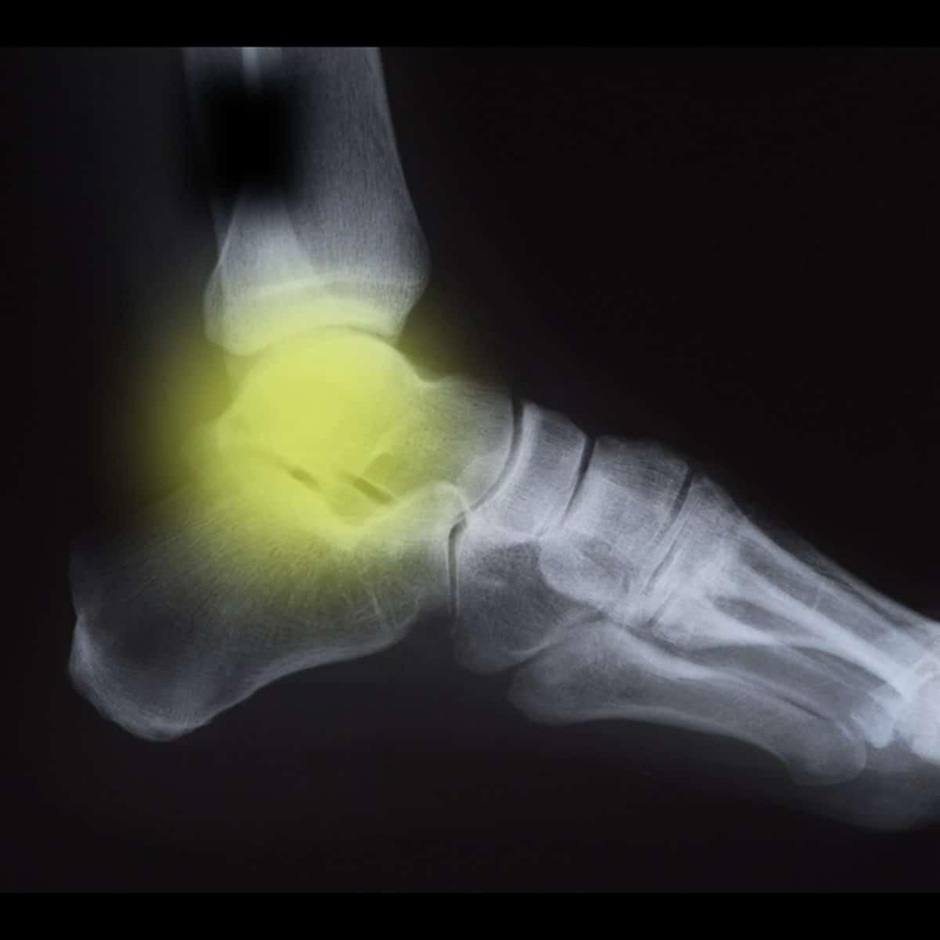 Symptoms of Arthritis in the ankle X-ray