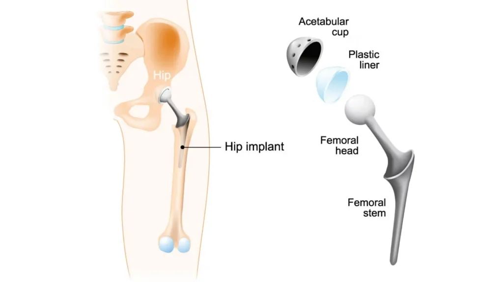 Total Hip Replacement Arthroplasty Implant Design