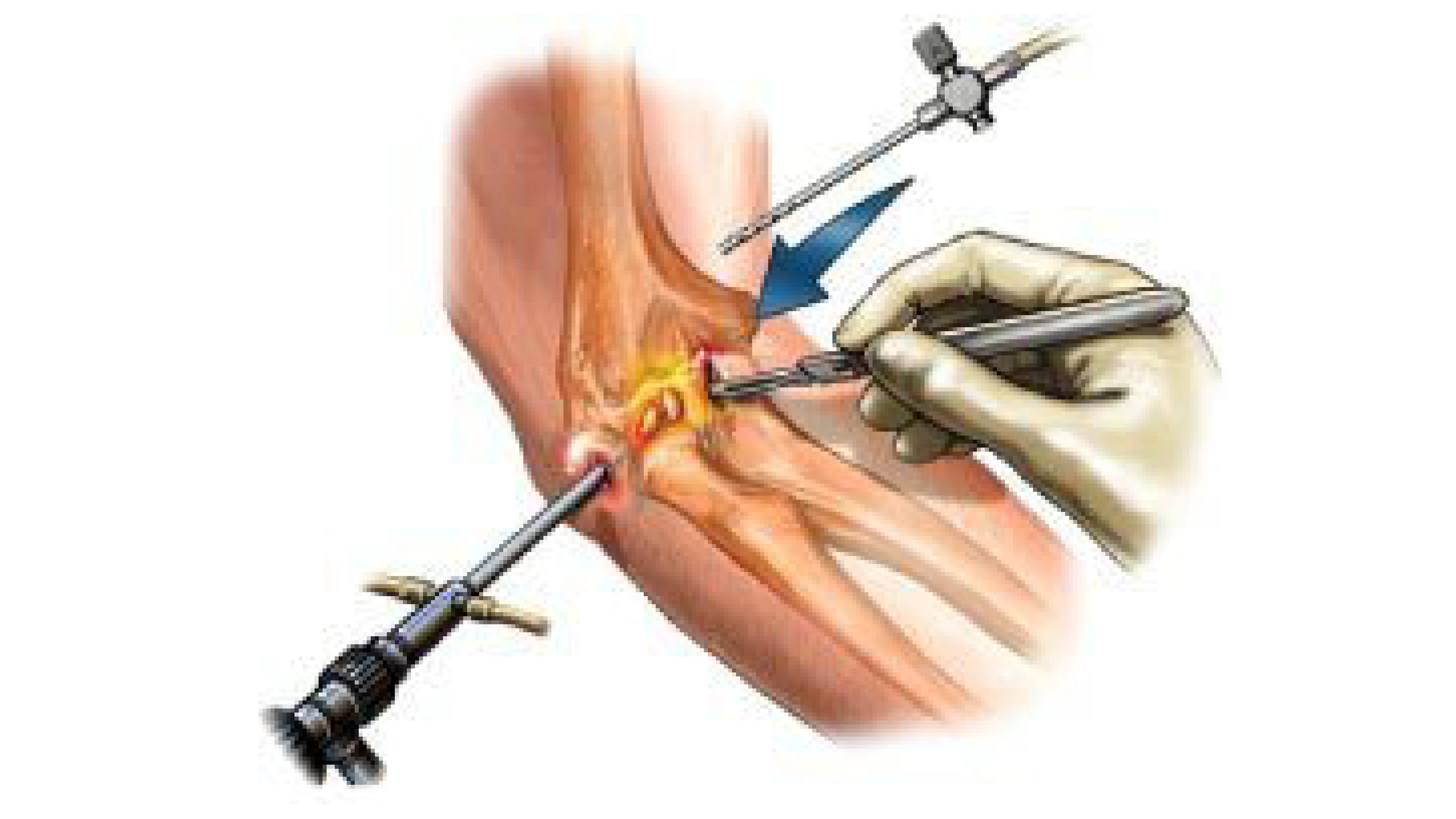 Treatments for Loose Bone Fragment in Elbow