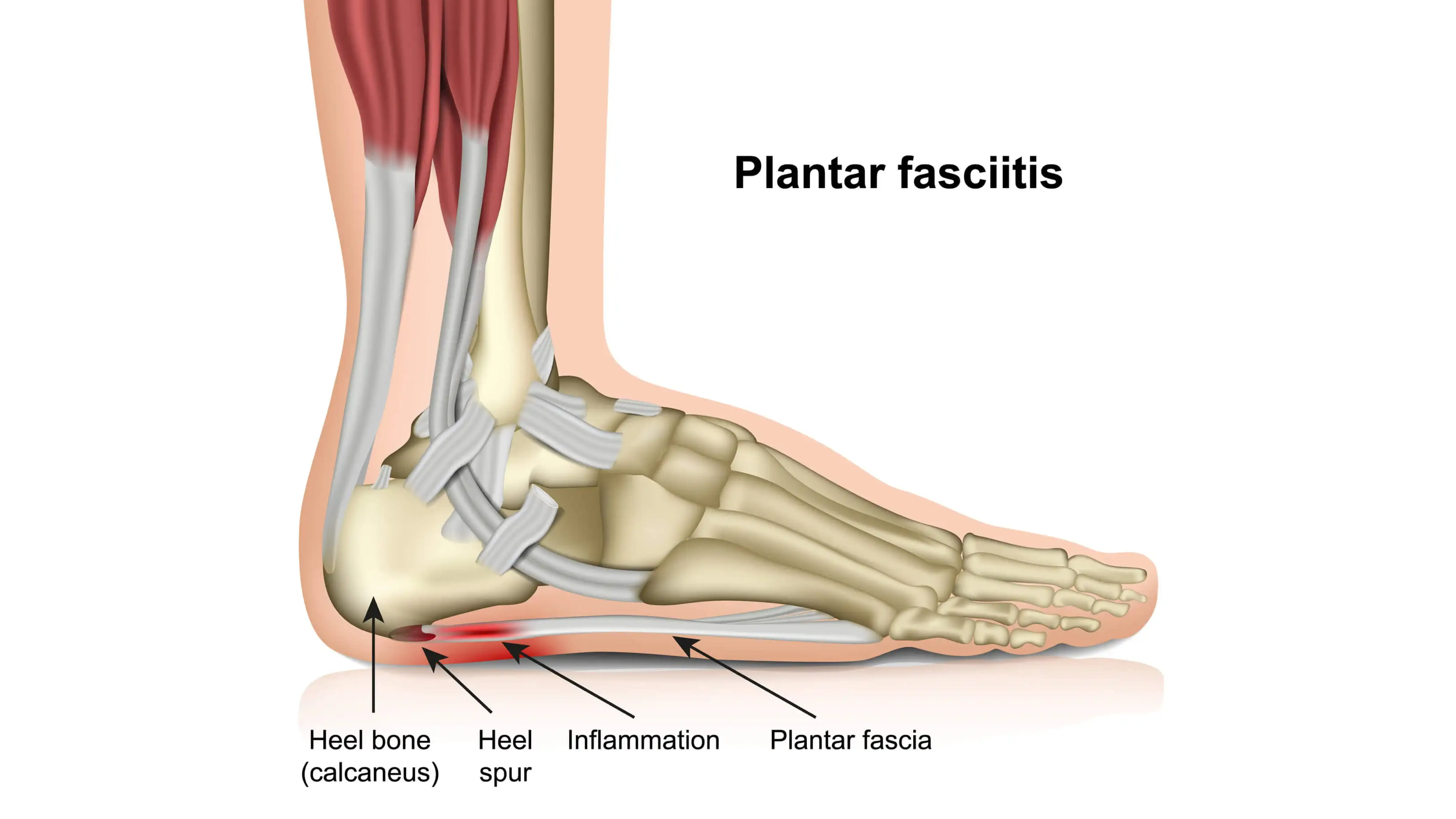 What is Plantar Fasciitis?