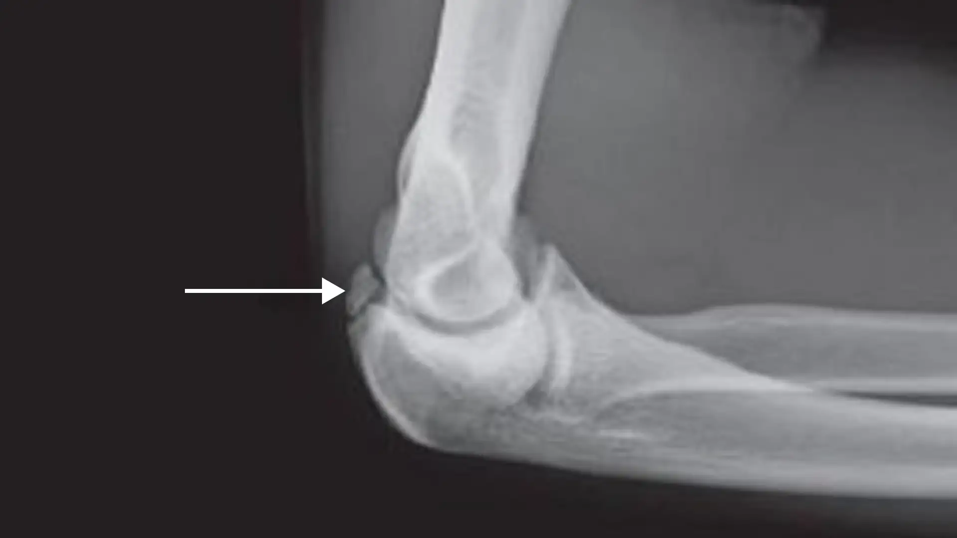 What is a Loose Bone Fragment in Elbow?