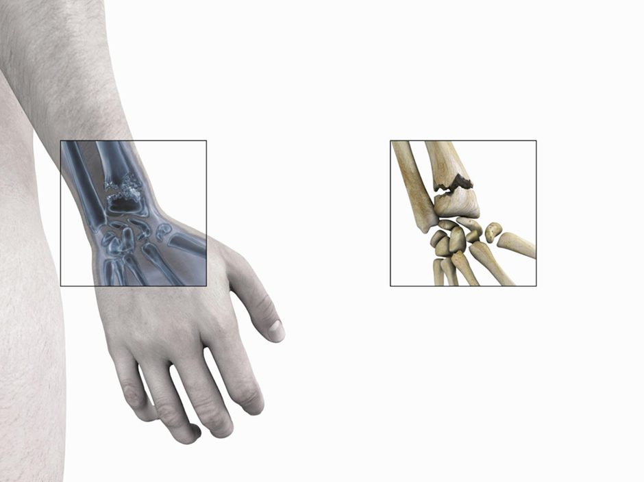 Hand Fracture diagnosis with anatomical graphic of what fracture looks like