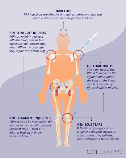 Areas that PRP are used to treat