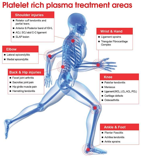 Platelet-rich plasma treatment areas
