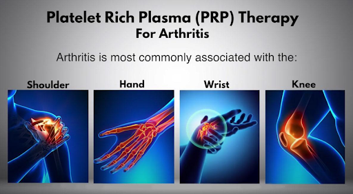 Platelet-rich Plasma (PRP) Therapy for Arthritis