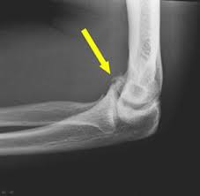 Loose Bone Fragment in Elbow – Diagnosis